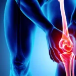 Pourquoi-quand-envisager-arthroplastie-du-genou